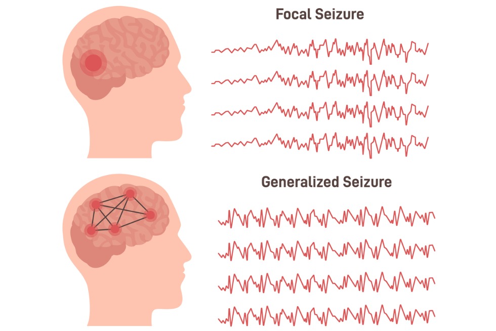 Types of Seizures<