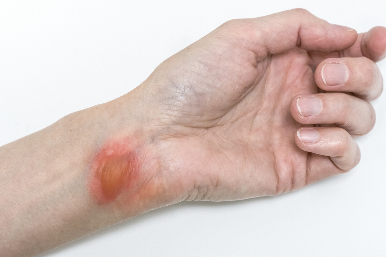 Scald Prevention Training
